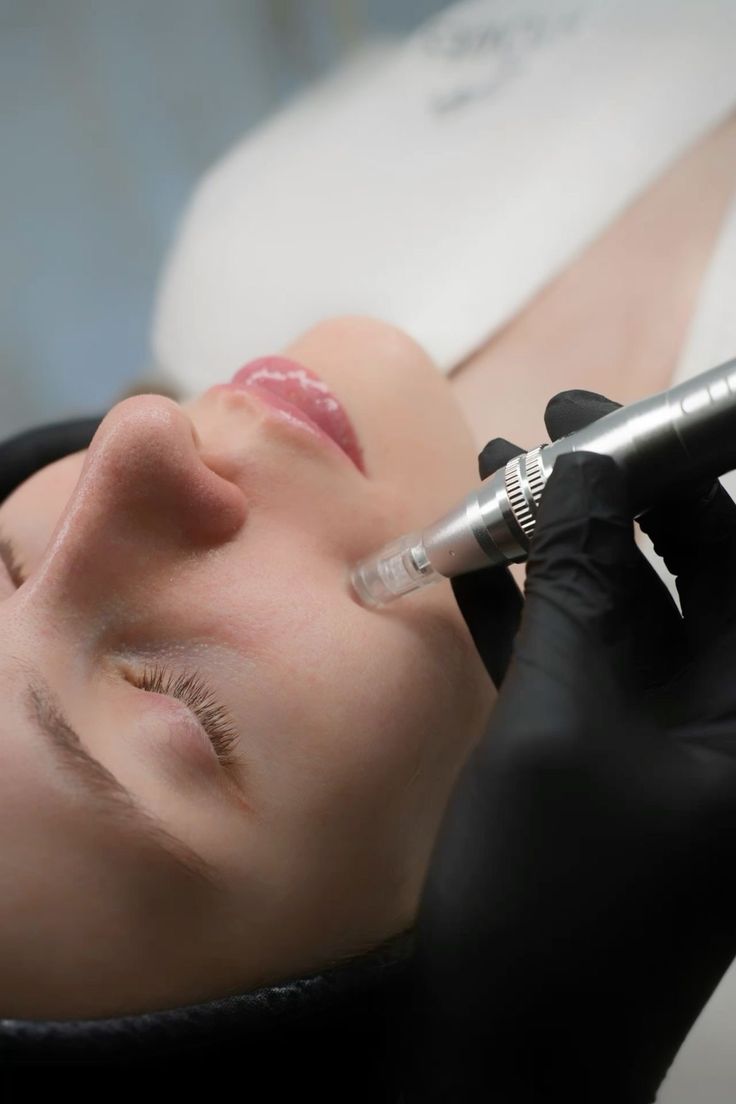 Microneedling